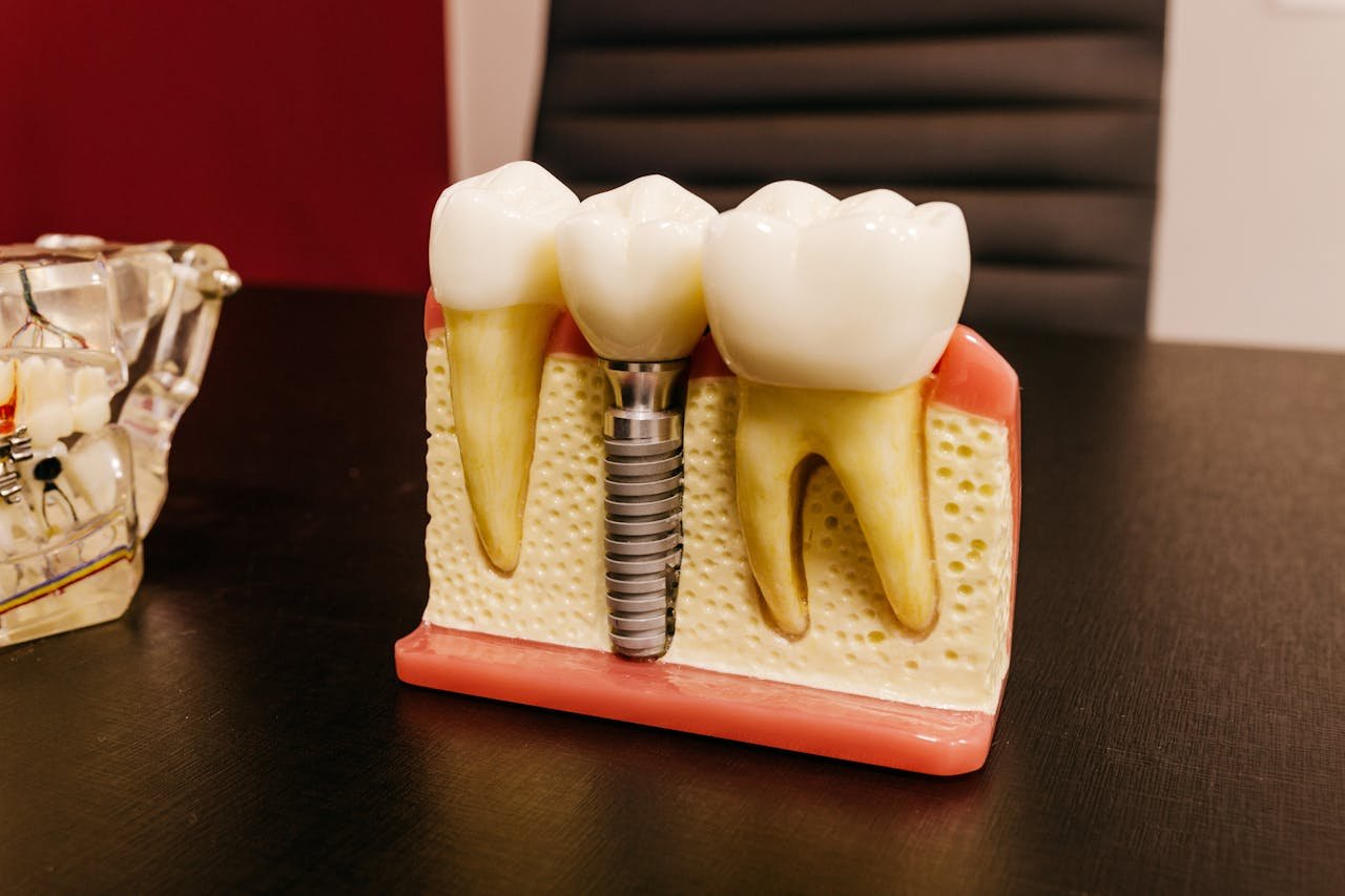 Implant Dentistry
